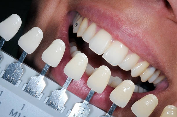 teeth whitening Cleveland