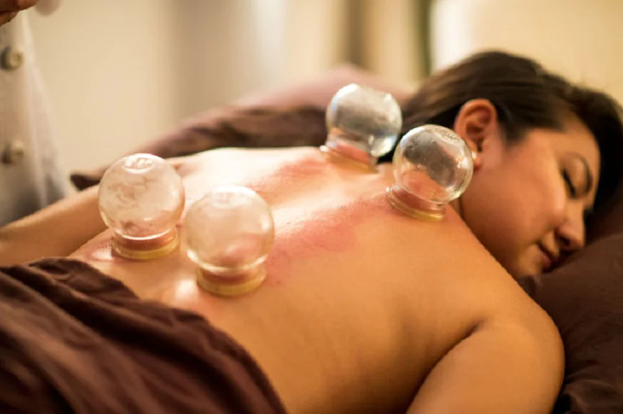 cupping treatment Melbourne
