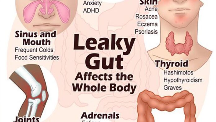 Leaky Gut Syndrome Melbourne