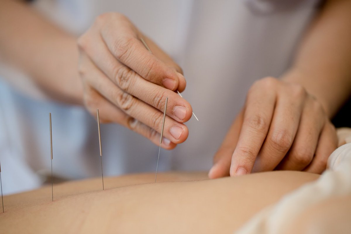 dry needling Melbourne