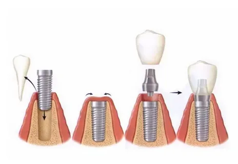 Dental Implants Dulwich Hill